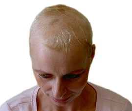 Narbige Alopezie / Vernarbender Haarausfall - HAARAUSFALL ...